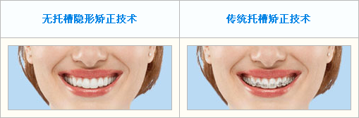 无托槽隐形矫正与传统托槽矫正的区别对比