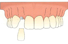 种植牙模拟过程